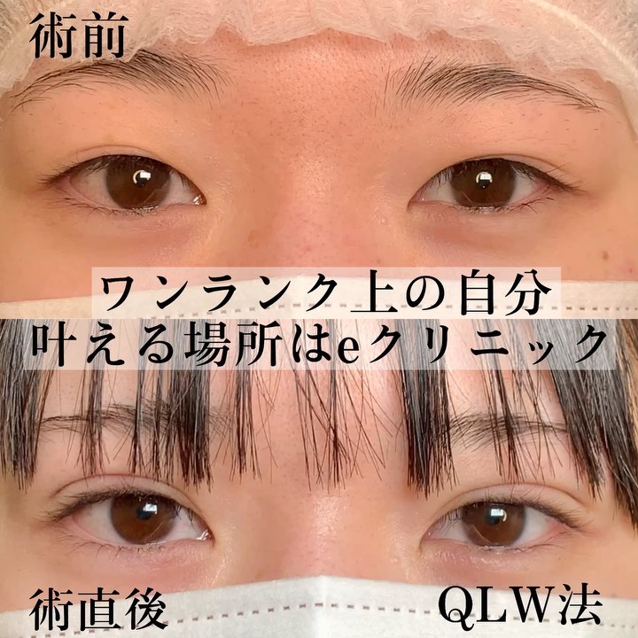 eclinic那覇院の埋没法(クイックループダブル)(裏留め4点)