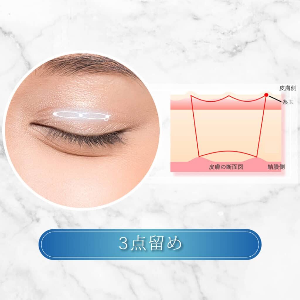 埋没法 3点留め