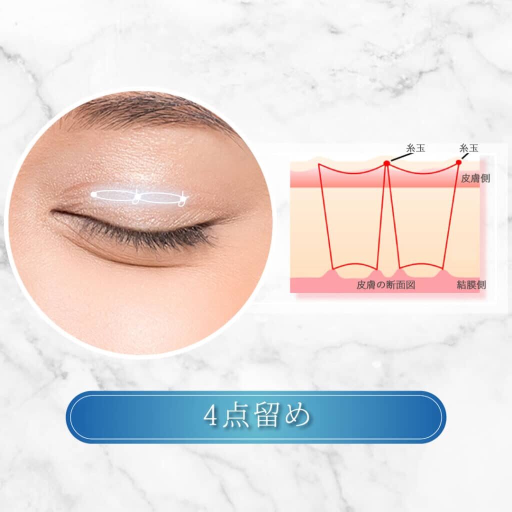 埋没法 4点留め