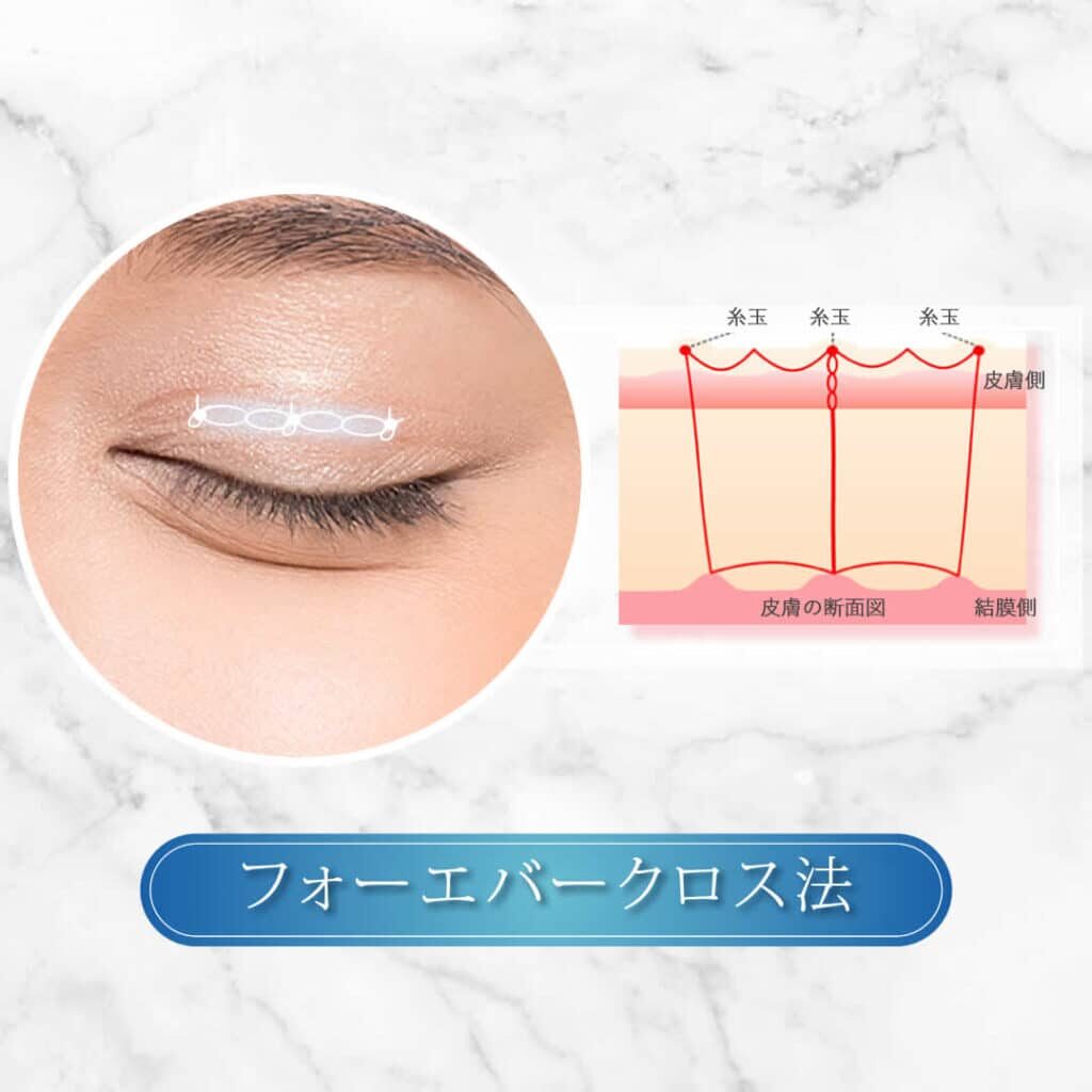 埋没法 フォーエバークロス