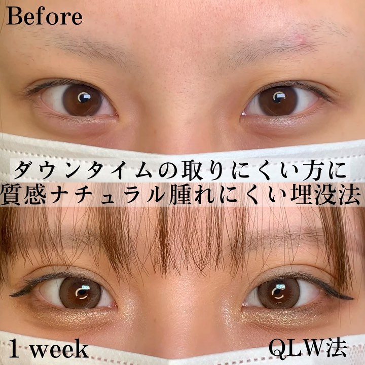 eclinic那覇院の埋没法(クイックループダブル)(裏留め4点)