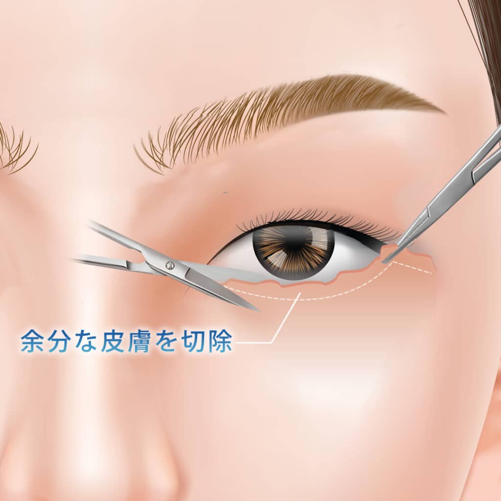 表ハムラで余分な皮膚を切除している図解