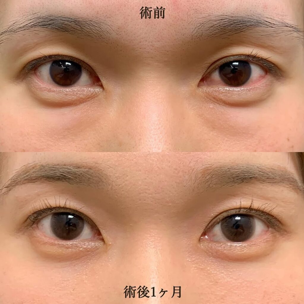 eクリニック那覇院の経結膜脱脂＋脂肪注入