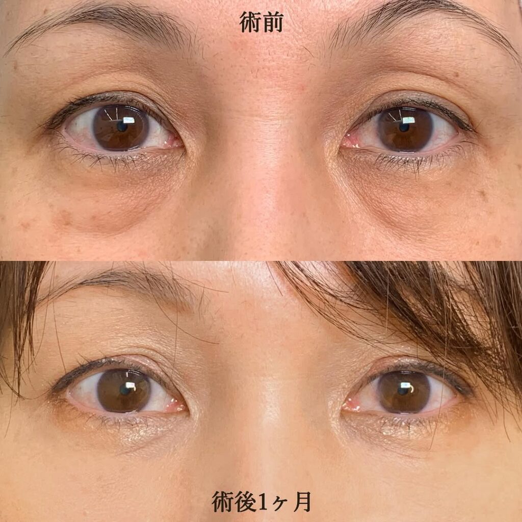 eクリニック那覇院の経結膜脱脂＋脂肪注入