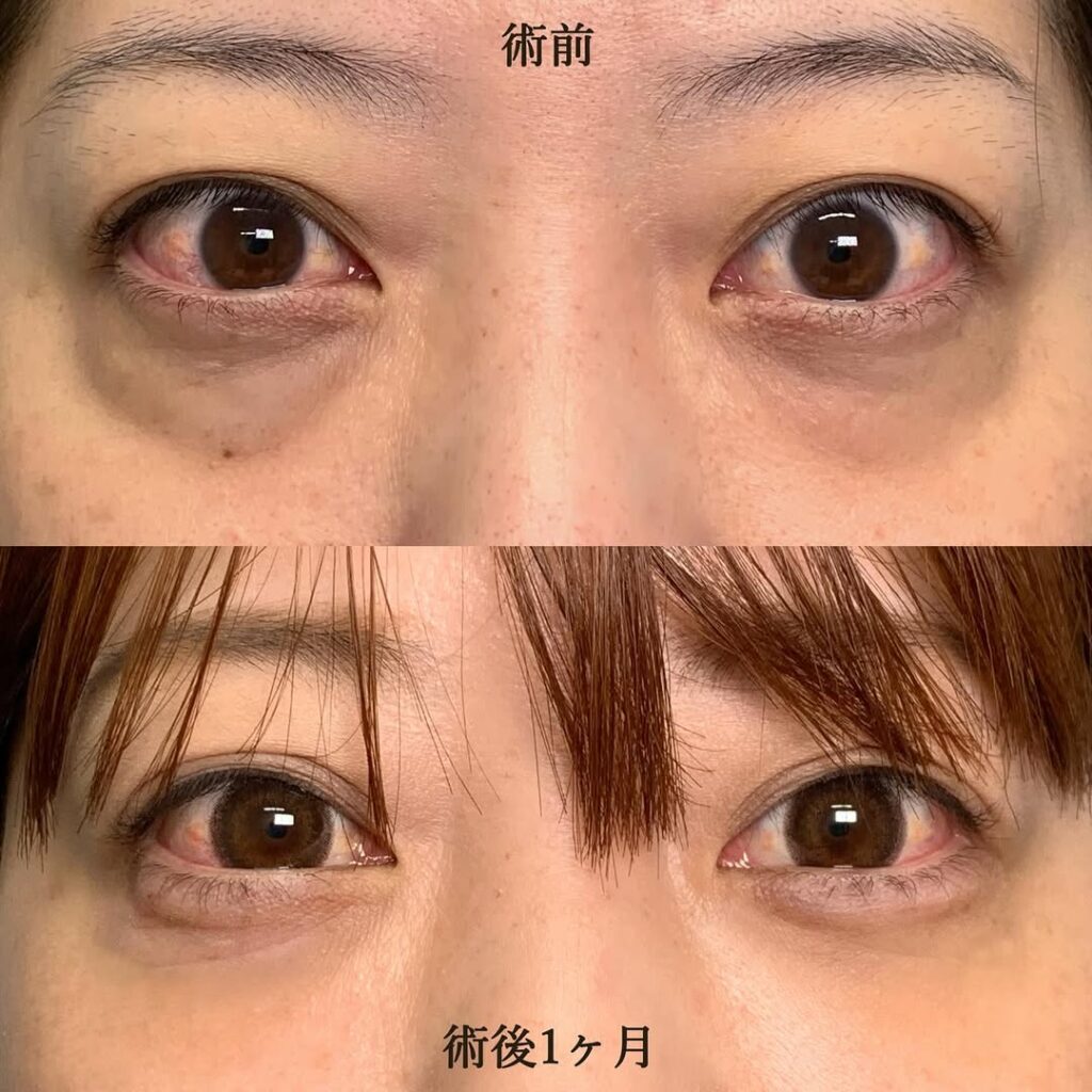 eクリニック那覇院の経結膜脱脂＋脂肪注入