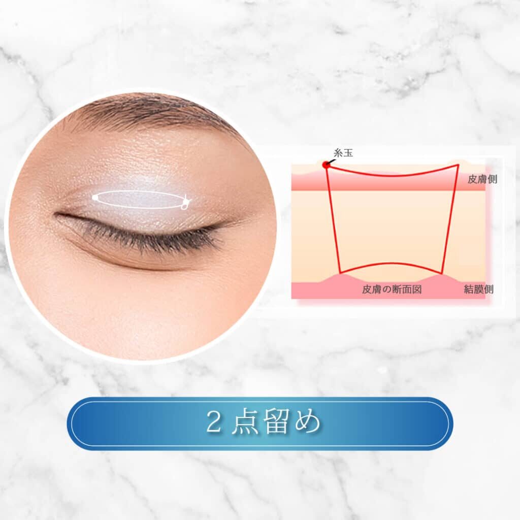 埋没法 2点留め
