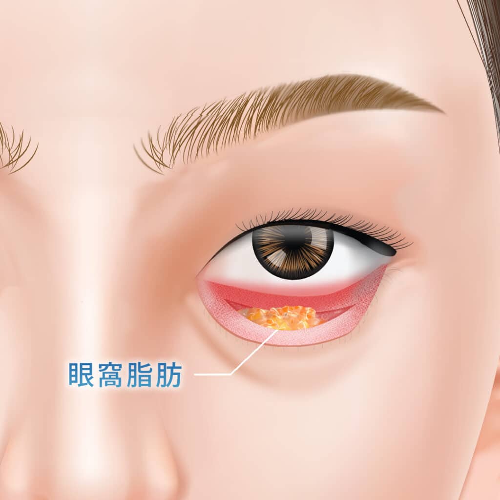 経結膜脱脂で眼窩脂肪を出している図解