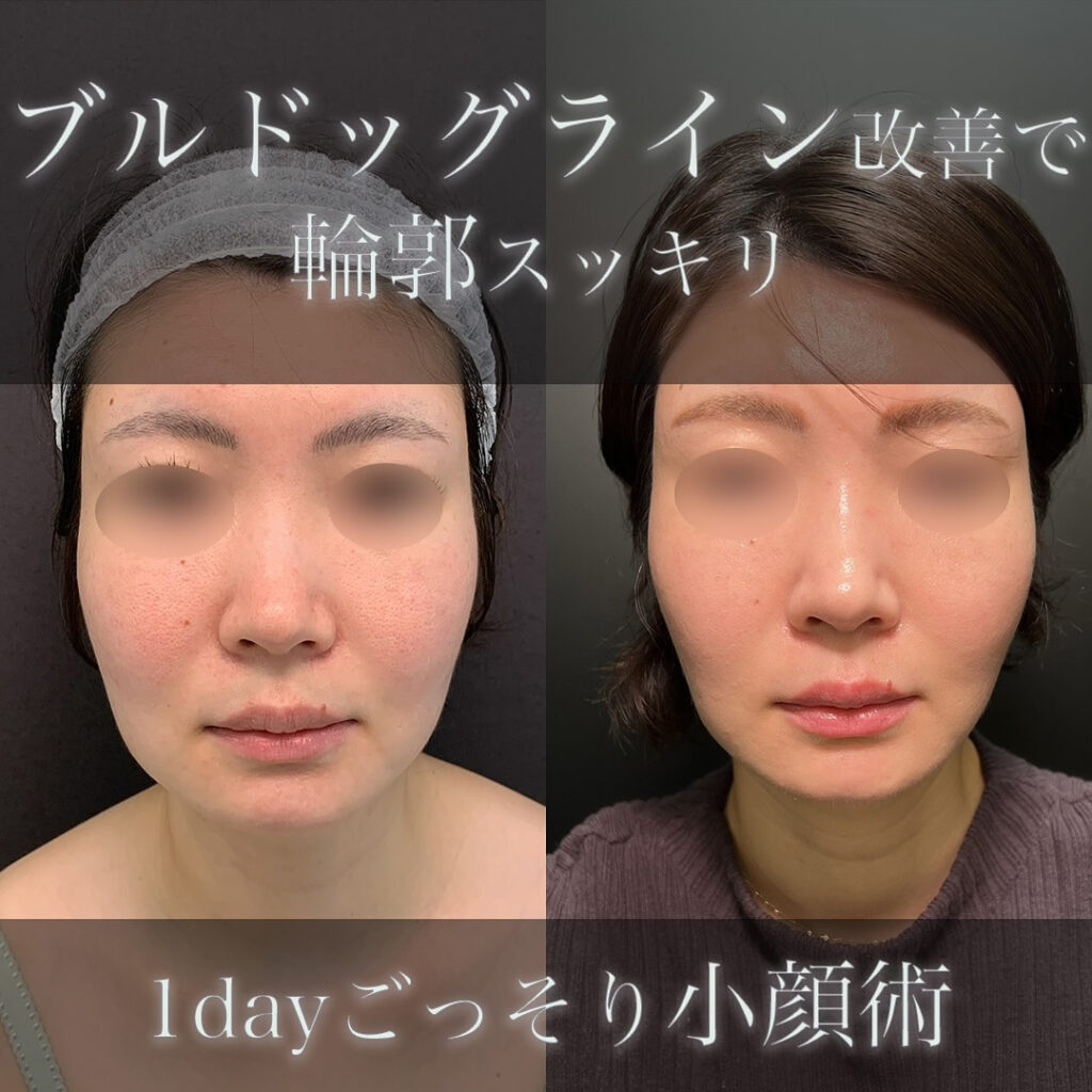 1dayごっそり小顔の脂肪吸引の症例写真