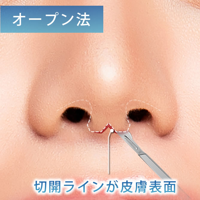 オープン法の切開ラインのわかりやすい図解