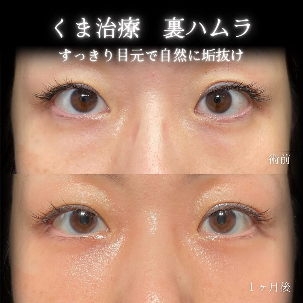 eクリニック那覇院の裏ハムラの症例画像(5)
