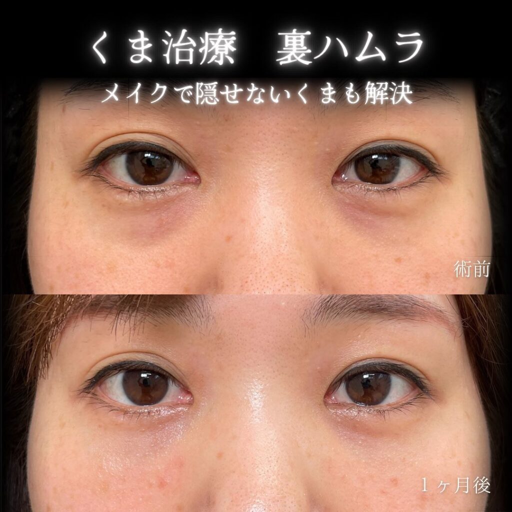 eクリニック那覇院の裏ハムラの症例画像(4)