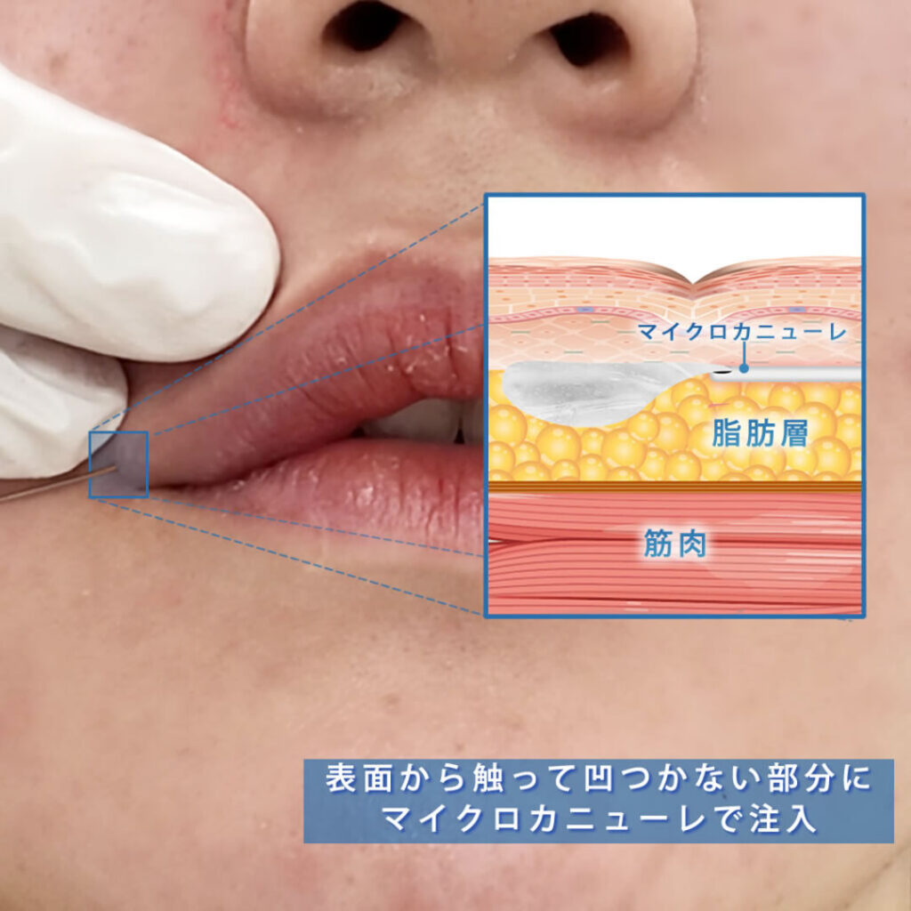 唇にヒアルロン酸を注入している所