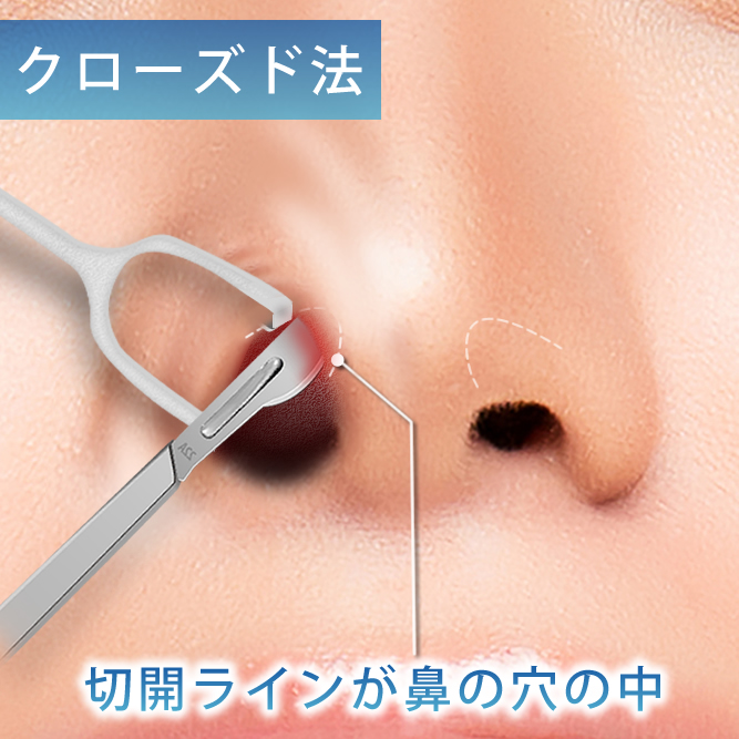 クローズド法の切開ラインの分かり易い図解