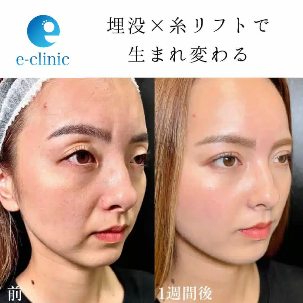 埋没+糸リフトの症例写真