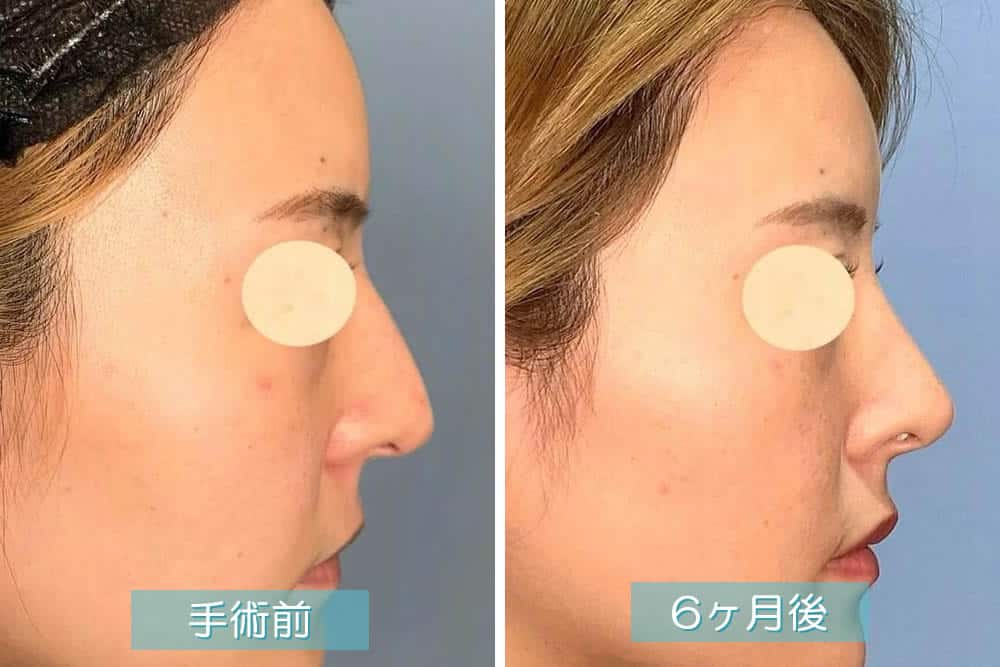 鼻尖部軟骨移植の３ヶ月後の症例写真