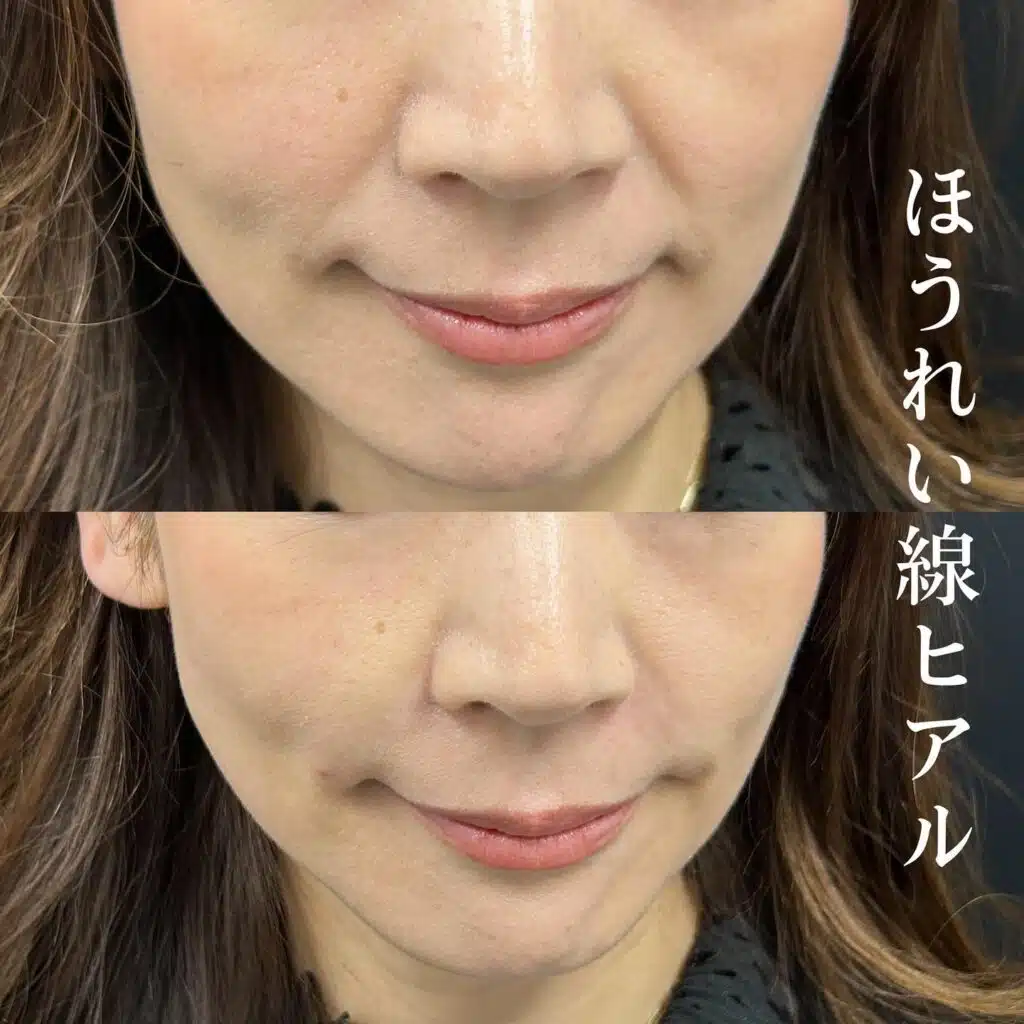 ほうれい線 ヒアルロン酸