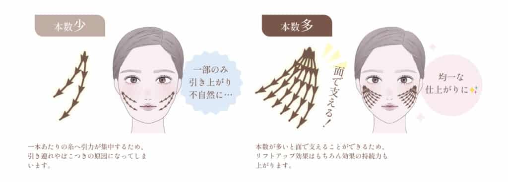 糸リフトの本数が違う時の効果を比較したもの