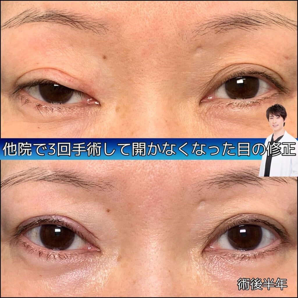 eclinic那覇院の全切開二重術の他院修正