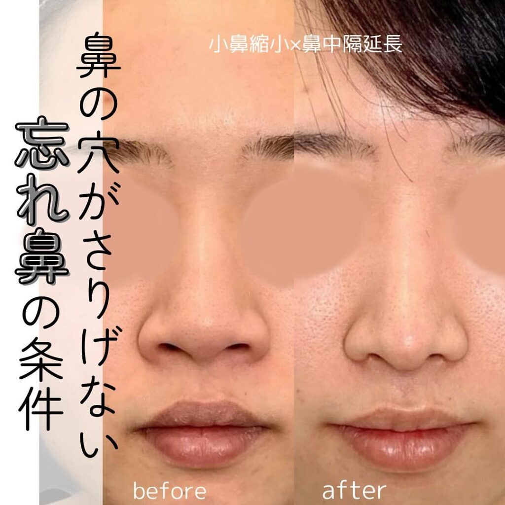 小鼻縮小＋鼻中隔延長の症例写真