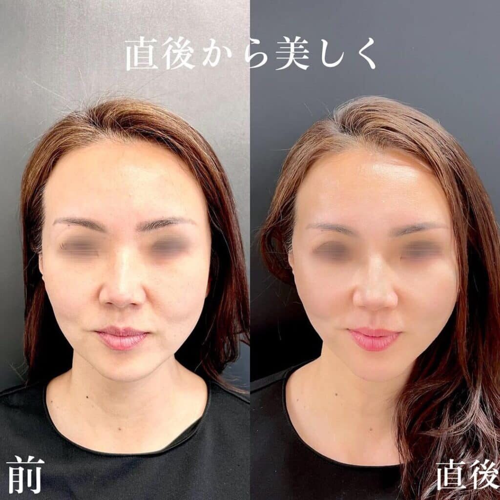 糸リフトの症例写真
