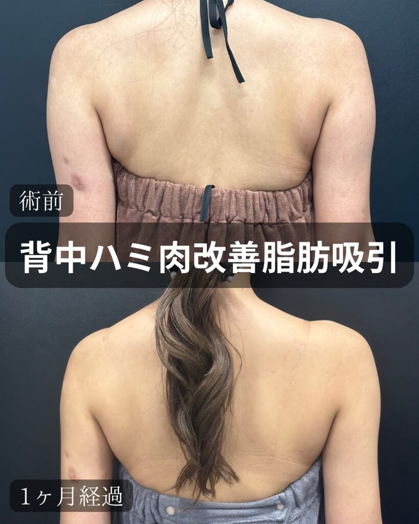 背中の脂肪吸引の症例写真 (1)