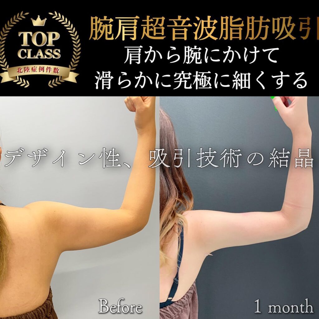 腕肩の超音波脂肪吸引