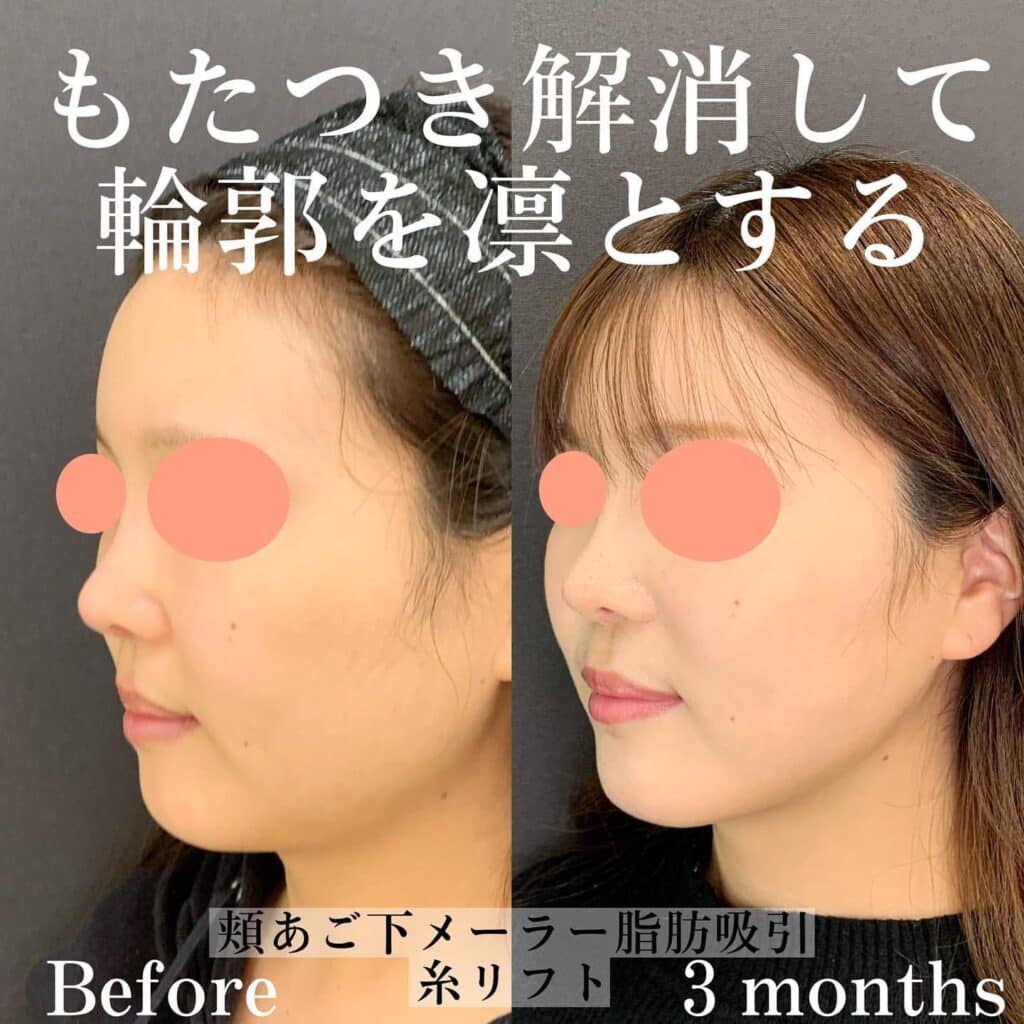 頬あご下メーラー脂肪吸引+糸リフトの症例写真