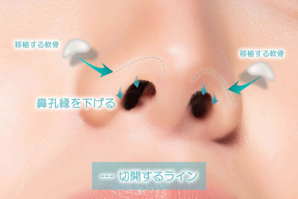 鼻孔縁軟骨移植