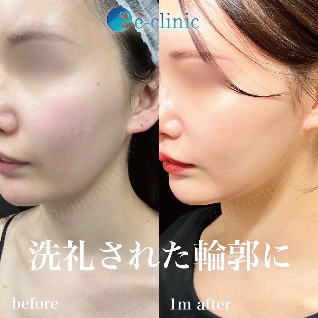 糸リフトの症例写真