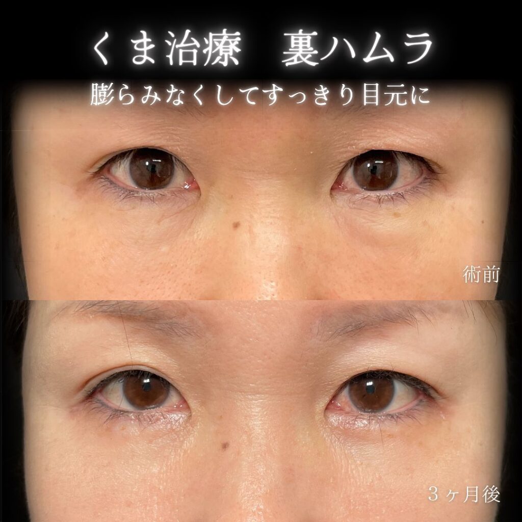 eクリニック那覇院の裏ハムラの症例画像(6)