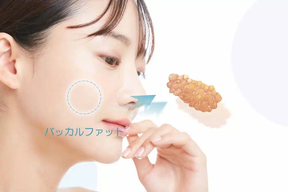 バッカルファット