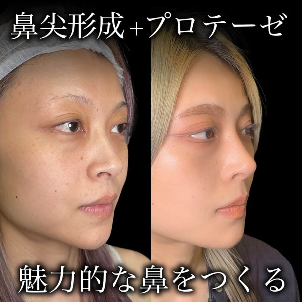 鼻尖形成＋プロテーゼの症例写真