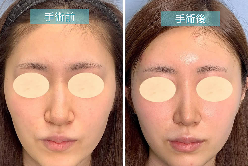 鼻中隔延長の症例写真