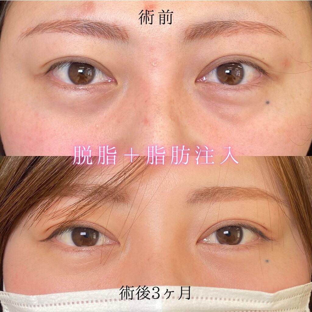 eクリニック那覇院の経結膜脱脂の症例写真（5）