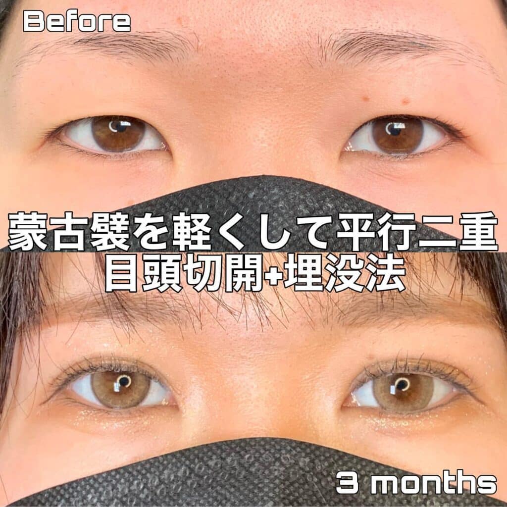 eclinic那覇院の二重埋没法+目頭切開