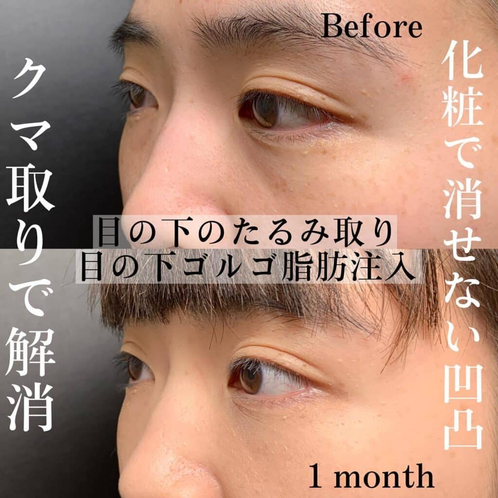 クマ取り_脱脂＋脂肪注入の症例写真