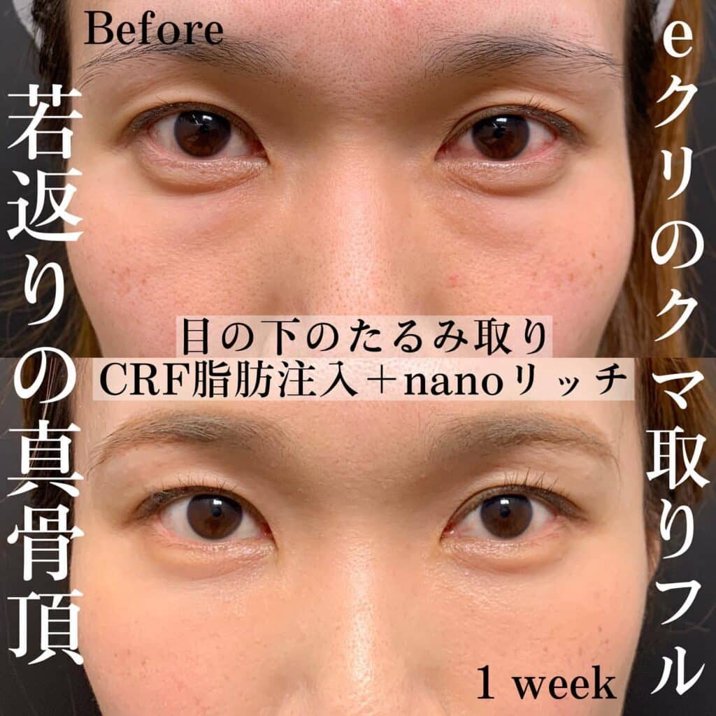 クマ取り_脱脂＋脂肪注入の症例写真