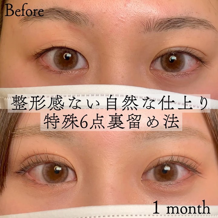 eclinic那覇院の二重埋没法(特殊6点裏留め)
