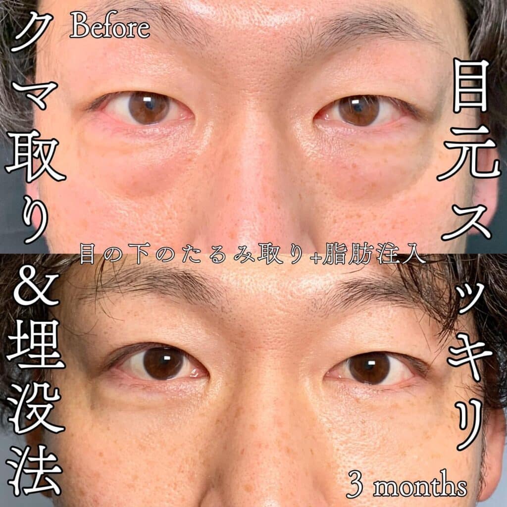 クマ取り_脱脂＋脂肪注入の症例写真