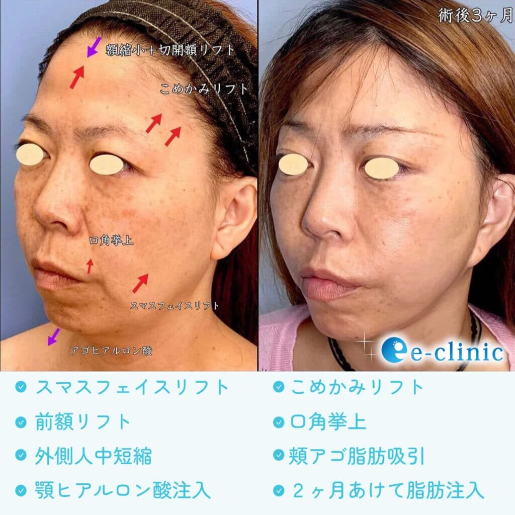 こめかみリフトの症例写真