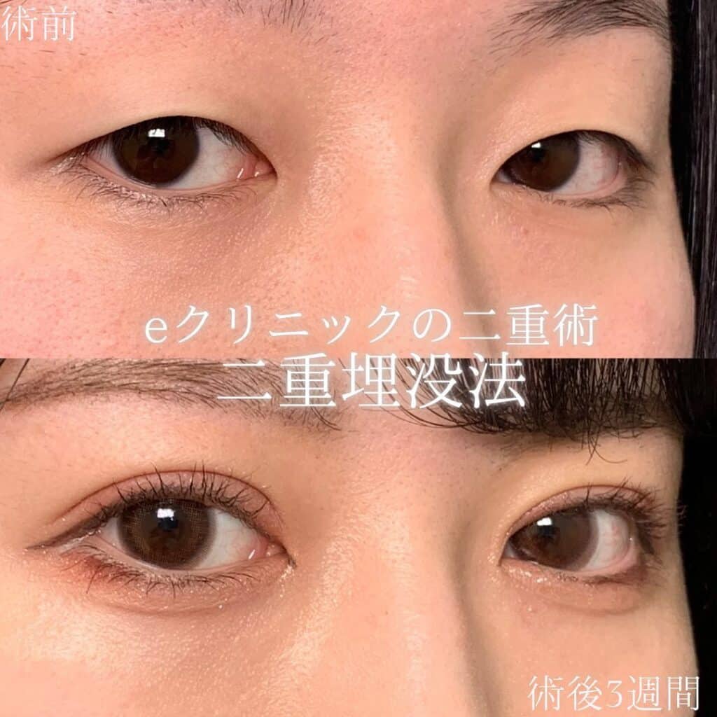 eclinic那覇院の二重埋没法