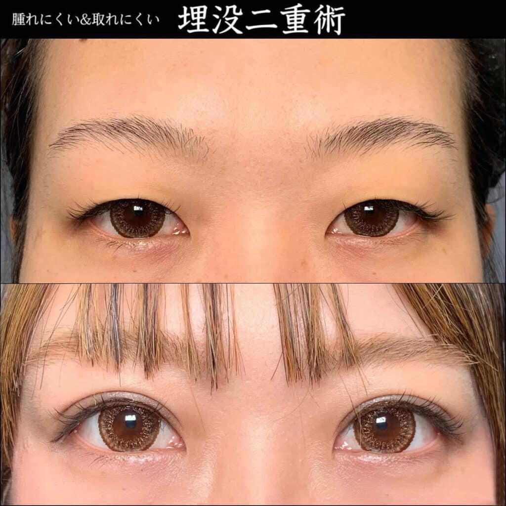 eclinic那覇院の二重埋没法