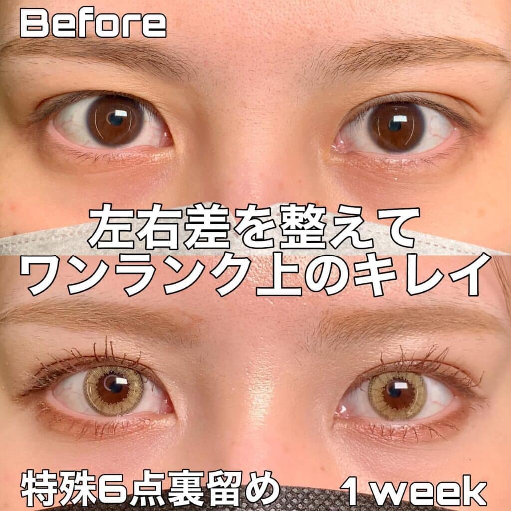 eclinic那覇院の二重埋没法(特殊6点裏留め)