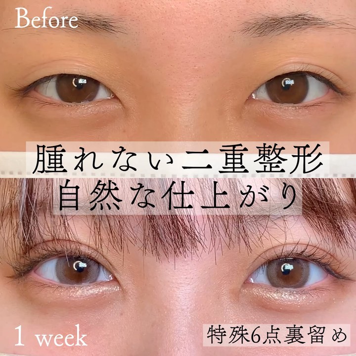 eclinic那覇院の二重埋没法(特殊6点裏留め)