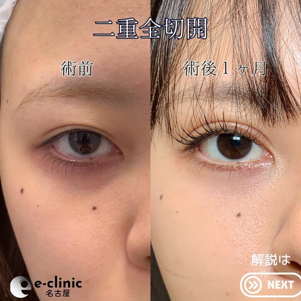 eclinic那覇院の全切開二重術