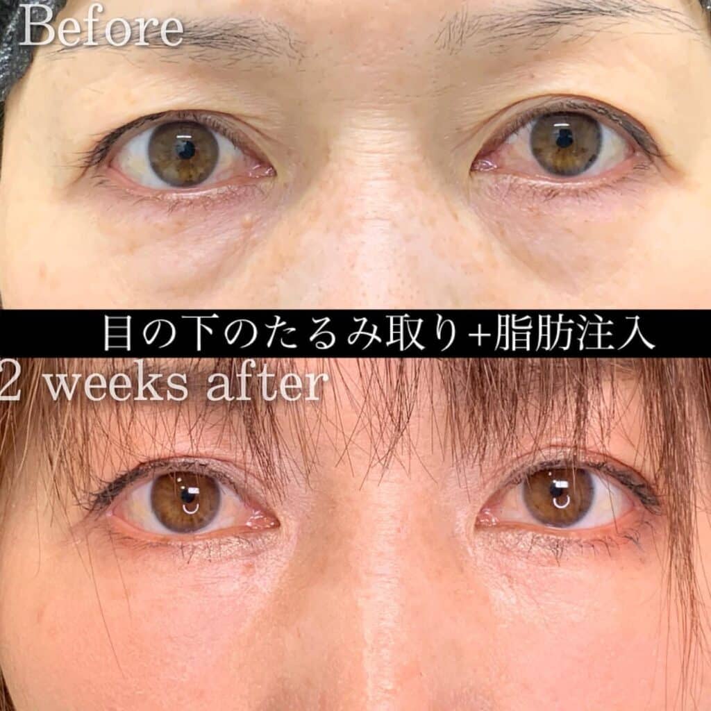 クマ取り_脂肪注入の症例写真