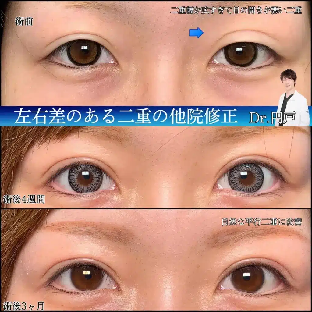 eclinic那覇院の二重埋没法の他院修正