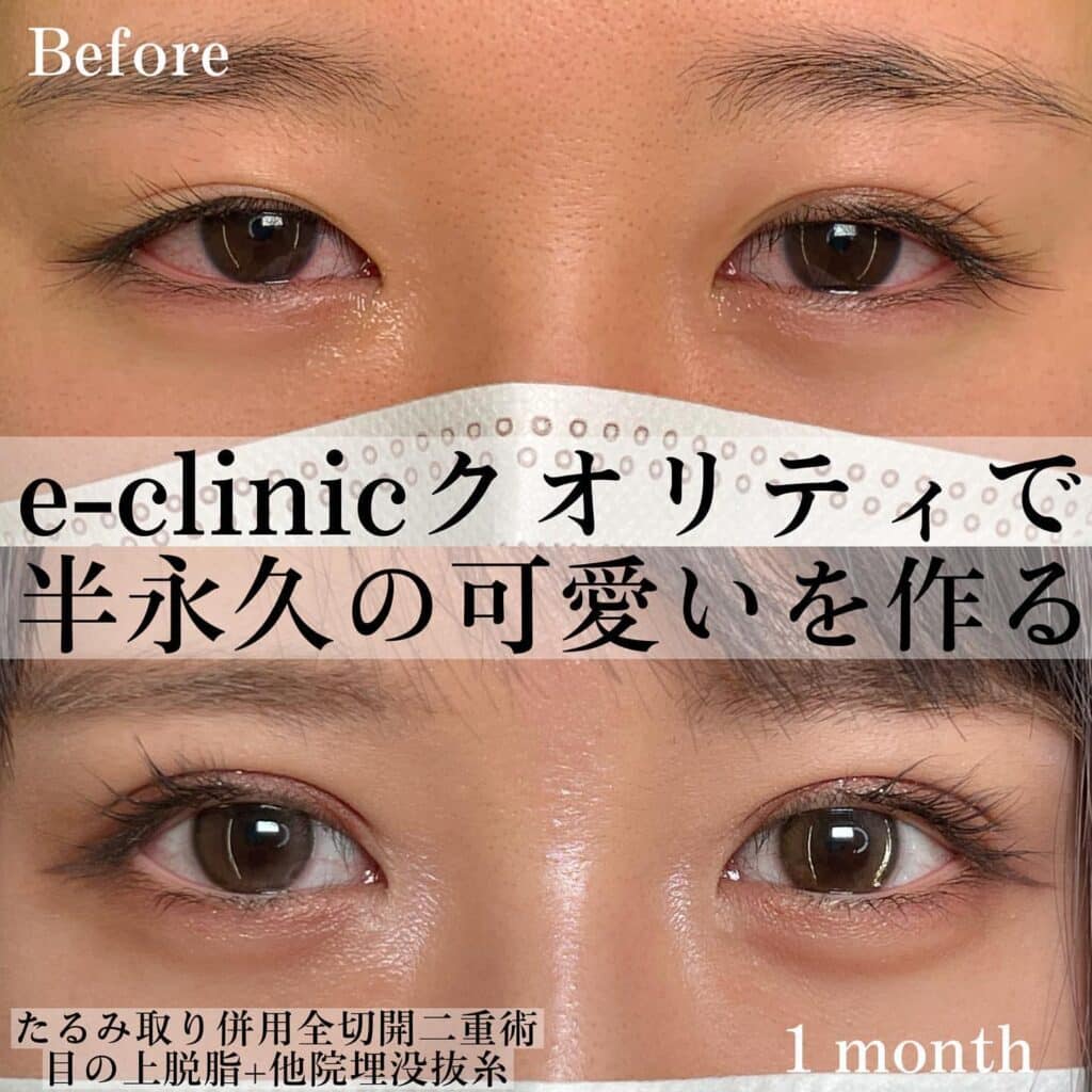 eclinic那覇院のたるみ取り併用全切開二重術+目の上脱脂+他院埋没抜糸