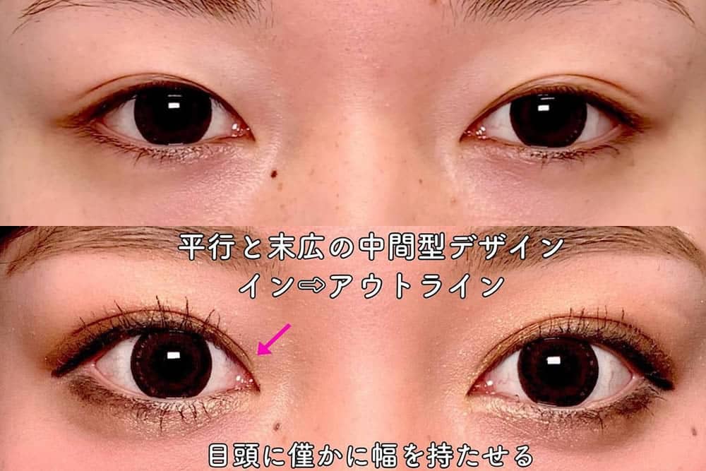 eclinic那覇院の二重埋没法