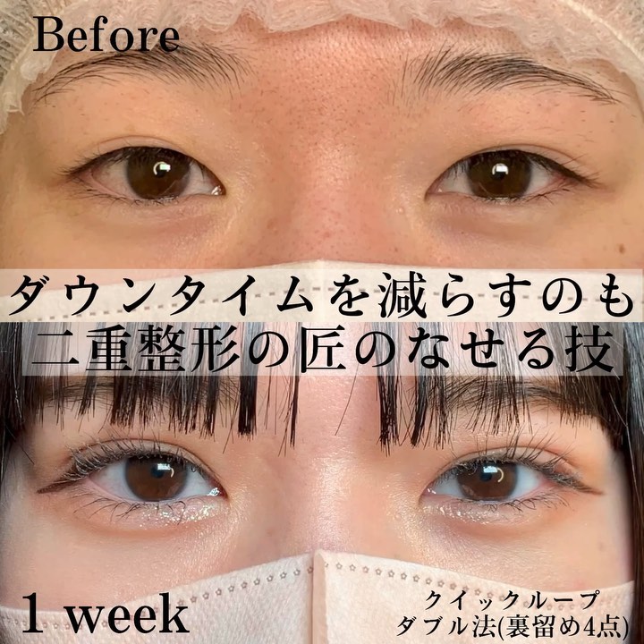 eclinic那覇院の二重埋没法(クイックループダブル法)(裏留め4点)